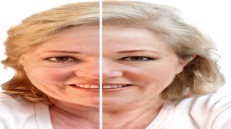 How the Eyelid Lift Surgery Could Benefit Sarasota, FL Residents