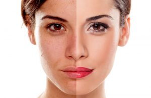 Are You a Good Candidate for the Less Invasive Partial Facelift?